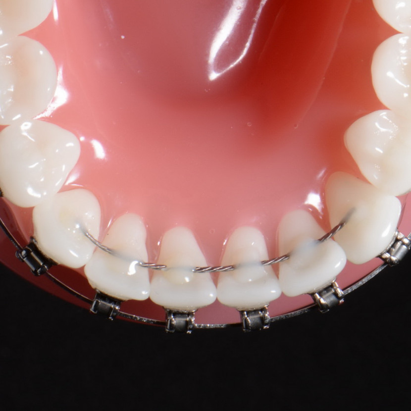 Retainer | Gerade Zähne - ein Leben lang | Kieferorthopädie